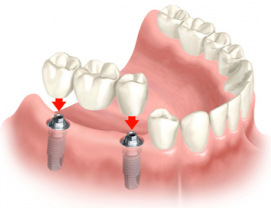 Имплантация зубов [category]