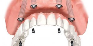 Имплантация зубов [category]