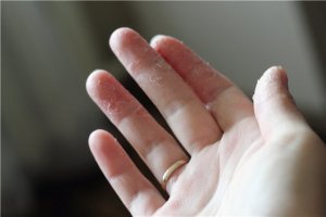 Шелушение кожи на руках